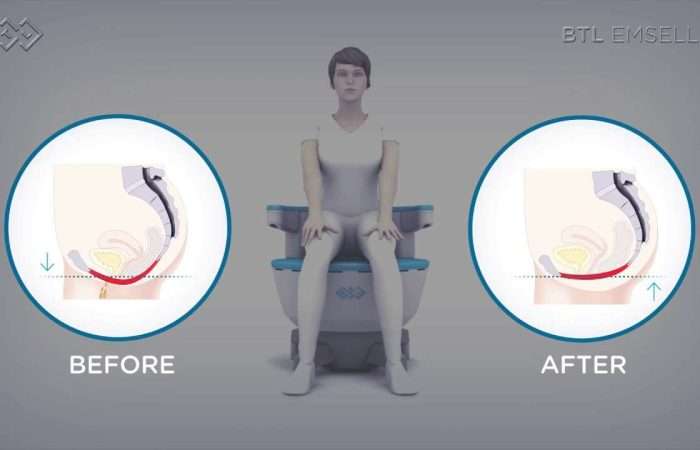 Emsella Chair Treatment